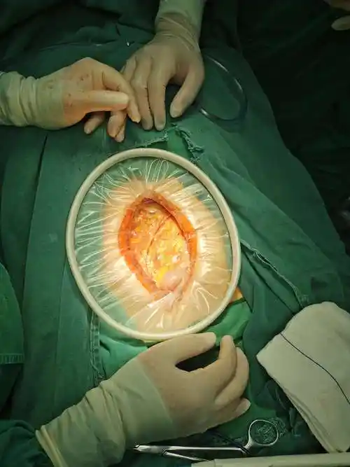 2020收官之作——右半结肠癌根治术