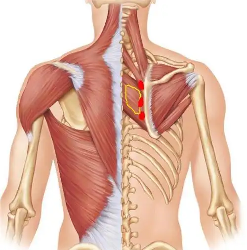 肩胛骨内侧痛之菱形肌激痛点解决方案 - 文章