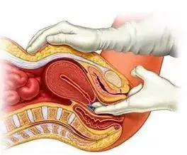 阴塞,肛塞给药,你真的知道怎么用吗?