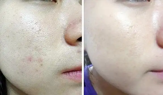 快速收缩毛孔的小妙招