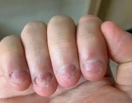 从小"咬指甲"的孩子,长大后怎样了?医生:一般逃不掉4种结果