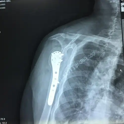 肩胛骨正侧位片与冈上肌出口位片投照要点*广东省中医院大学城运动
