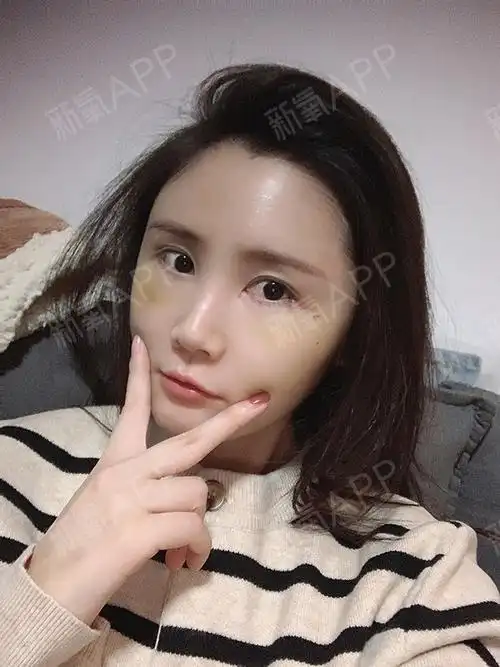 自体脂肪全面部填充恢复的第10天