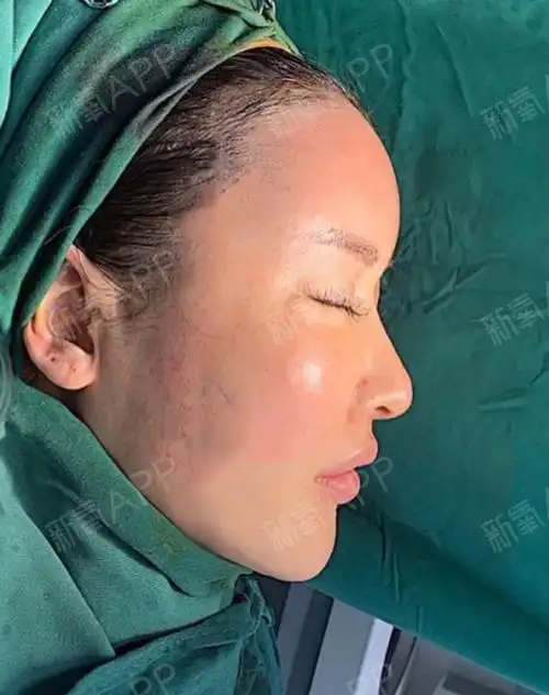 脂肪填充了额头,太阳穴,苹果肌,面颊,下巴  填充术后效果饱满,线条