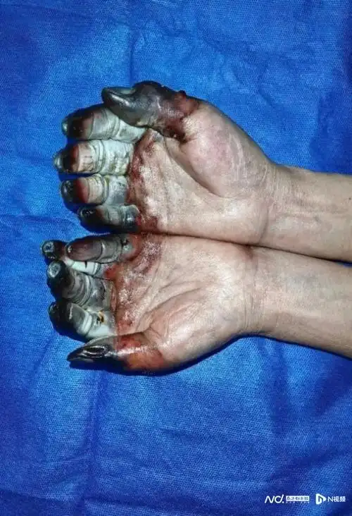 近期患者猛增有人被截肢医生紧急提醒