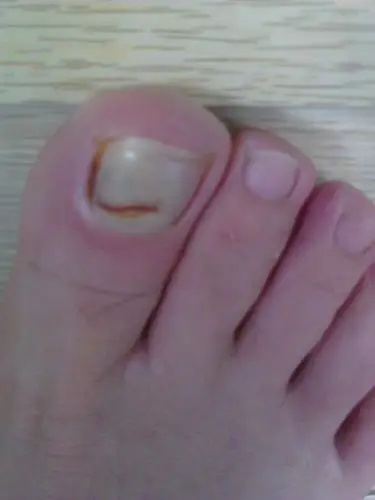 大脚趾打球时被踩的出血,两天后化脓,本人上班,需穿皮鞋?