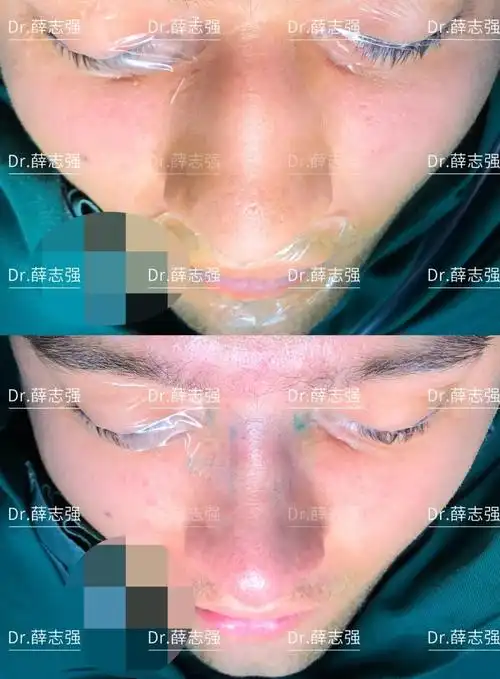 内入路保留鼻整形丨外国帅哥的驼峰鼻矫正