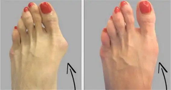 女性要想穿鞋美拇外翻一定要重视大脚趾这些危害你知道吗