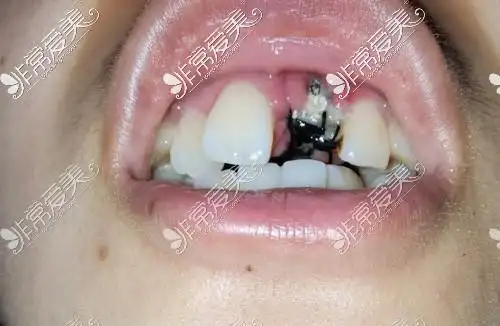 种植牙一期失败的症状我感觉我种牙失败了但医生不承认