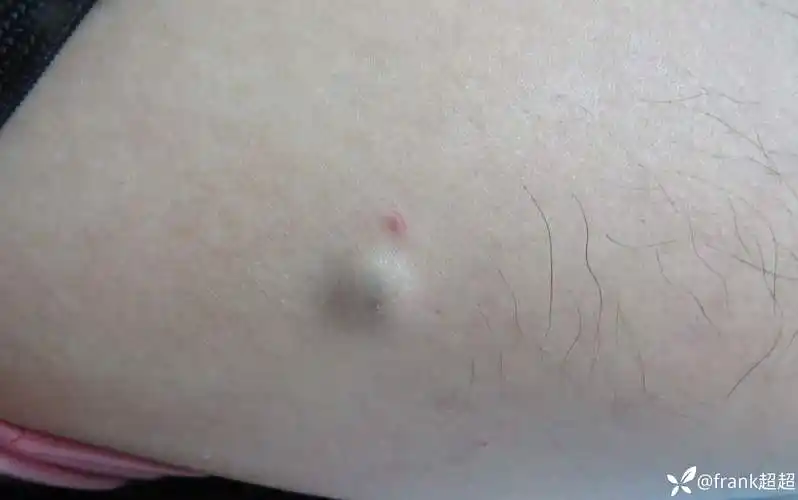 看图诊断右大腿处囊肿偶尔挤出豆腐渣样物质伴臭味常见病例分享