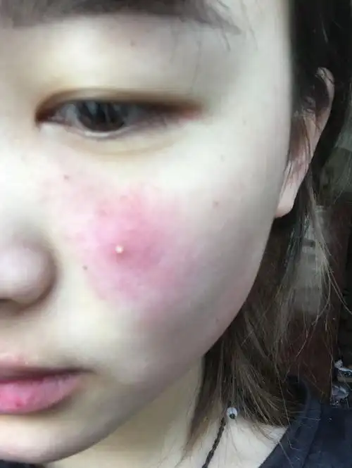 昨天脸上起了个这个东西,红肿发疼,今天早上就冒了
