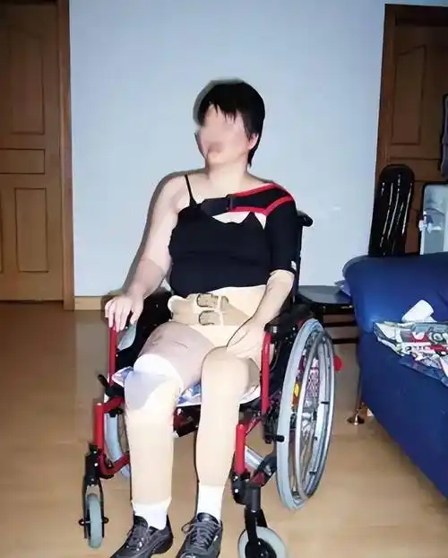 和左腿都没有了,但是她还不清楚自己的右脚也被医生做了截肢的手术,她