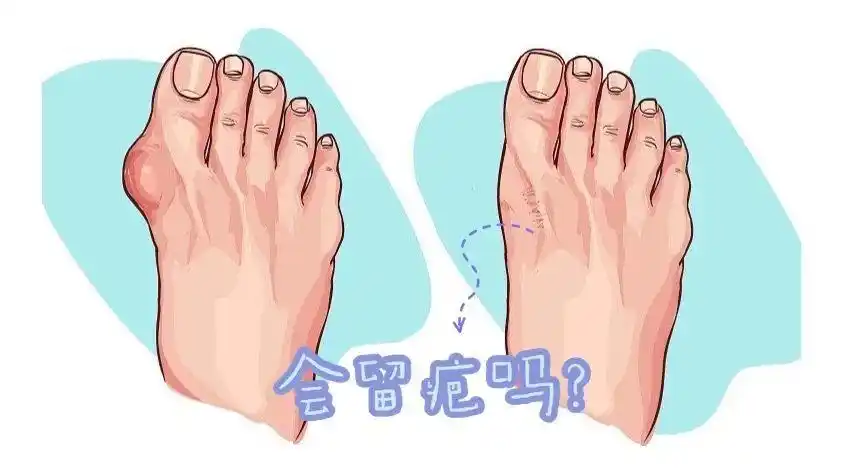 拇外翻一定要手术治疗吗手术会留疤吗拇外翻手术刀疤大吗