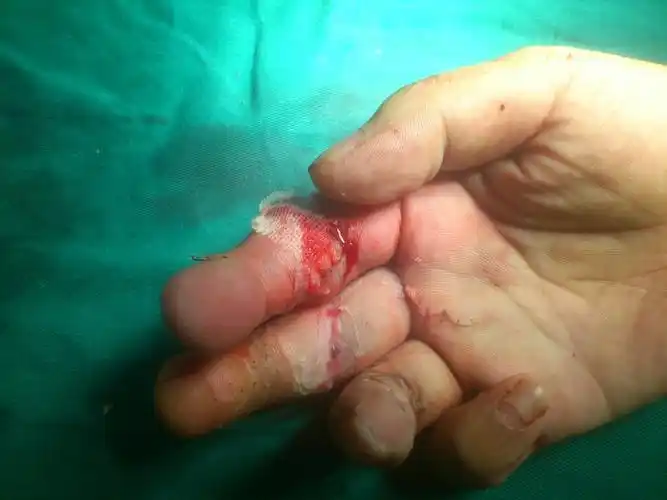 手指再造有哪几种方法