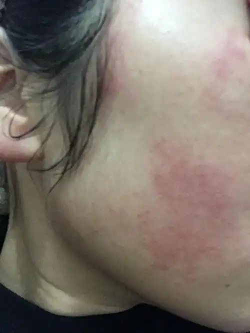 我的脸,十天之内过敏三次了,不知道咋回事,有没有医生帮忙看看_百度知