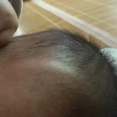 宝宝头顶高是怎麼回事?