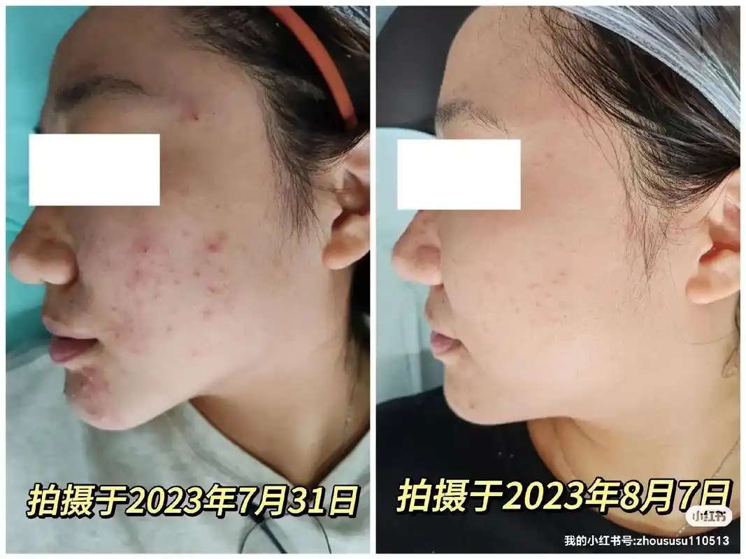 【东直门皮肤科招募】效果绝绝子!9999.