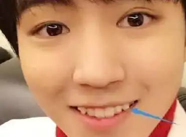 人为什么会长虎牙?有人说长虎牙的人有点"虎",你认可吗?