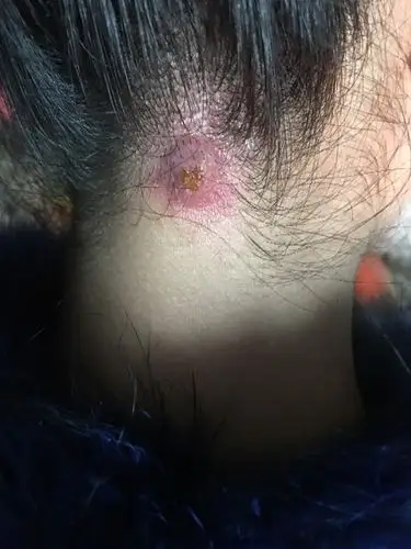 2018-01-08   最佳答案 这个是疖子汇成了痈,必须外科门诊小手术