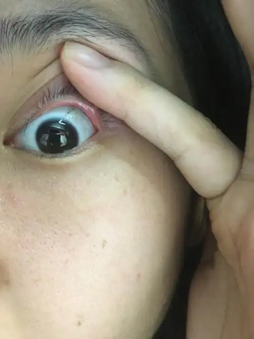 什么样算是流脓,多久会好?