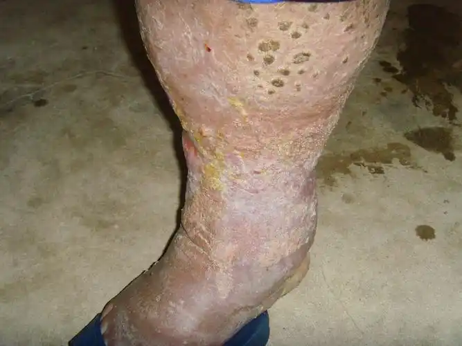 小腿溃烂 - 中医皮肤版 - 爱爱医医学论坛