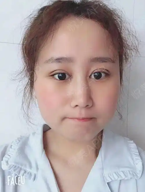 刚开始是犹豫了好久,到处的问身边的人"我适不适合做双眼皮",真的