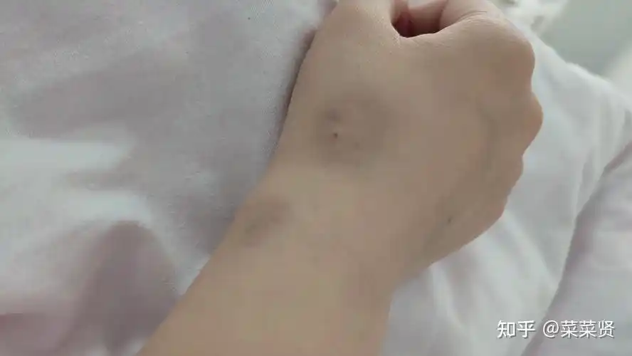 痔疮手术治疗记录.北京中日友好医院(完结)