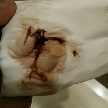 排卵期流血多久来月经怎么办排卵期后一直出血到下次例假