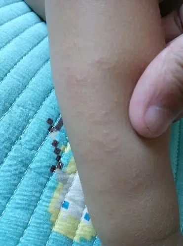 【宝宝脸过敏】宝宝皮肤过敏怎么办,宝宝皮肤过敏详细汇总