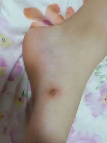 脚上起个肉疙瘩怎么治疗