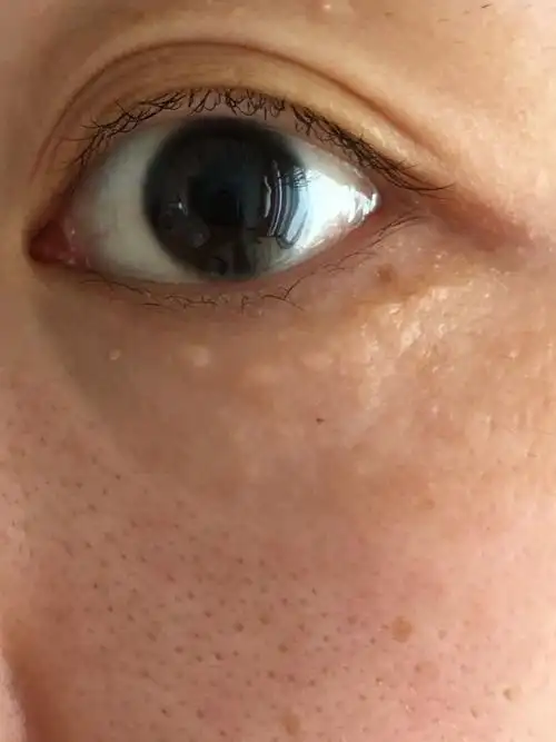 长了大概两年了,有人说是扁平疣,而且眼袋下面长斑.