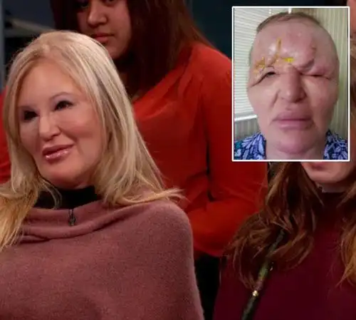 美国一大妈整容手术失败额头变形酷似外星人