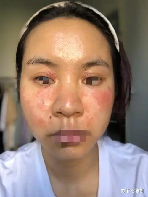 过敏7年的经历,从脂溢性皮炎到激素依赖性皮炎到过敏性鼻炎 过敏性皮