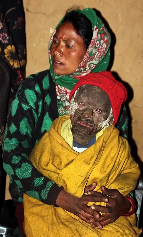 11年过去了,罕见的皮肤病抢走了nar kumari的行走能