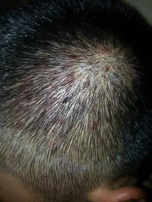 头皮起红点并且都破了,痒 还有大块头皮怎么回事?