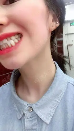 牙齿种植术后180天_种植牙术后180天_牙齿美容术后180天_悦mer