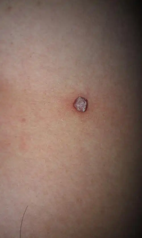 被我用手弄破以后现在长出了个3到4毫米的小肉瘤担心会不会是癌变呢?