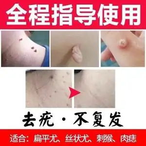 治瘊子肉粒疙瘩祛灵去除猴子脚底刺猴专用药肉刺痣膏瘊净断根