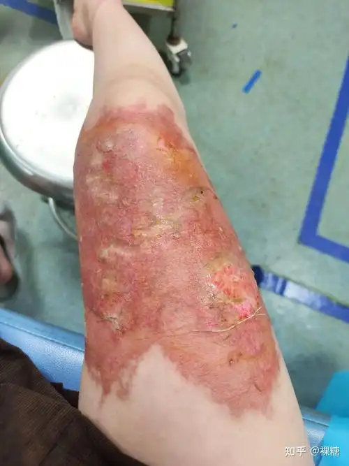 烫伤恢复记录 - 知乎