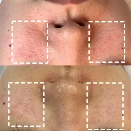 在管理前,可以明显看出小姐姐属于油性与敏感的混合性皮肤,鼻子有些油