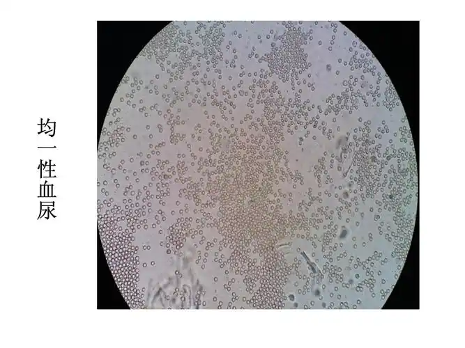 尿液红细胞位相课件_第4页