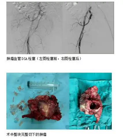 头条团队的力量市一院成功开展高难度半骨盆置换术