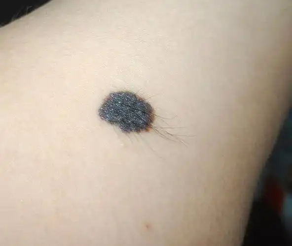 求助|手臂上的大痣