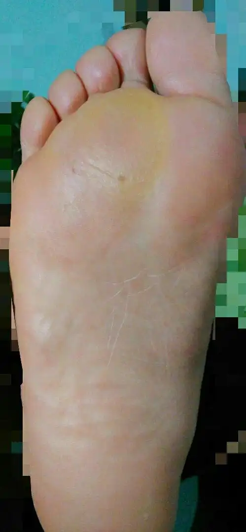 医生们麻烦帮忙看看,这个脚掌是怎么回事,肿了,特别疼,脚掌中间还有一
