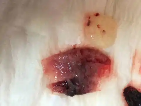 孕7 3胎停,自然流产,图片可能会引起部分人不适,慎点