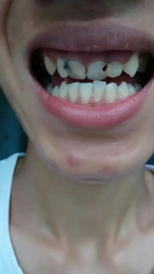 我这牙齿歪的严重吗.