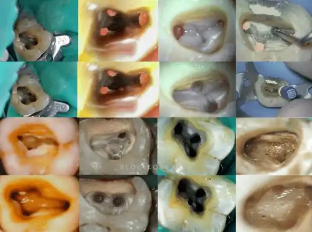 对于上颌第一磨牙的mb2来说过去是偶尔有,现在是偶尔没有,各种文献