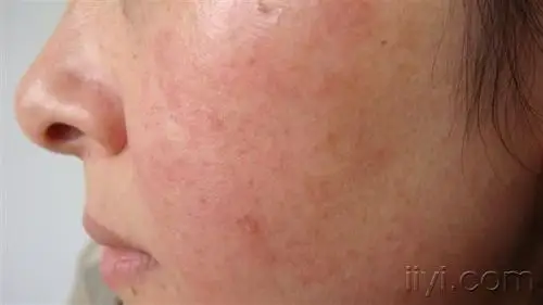 面部皮炎