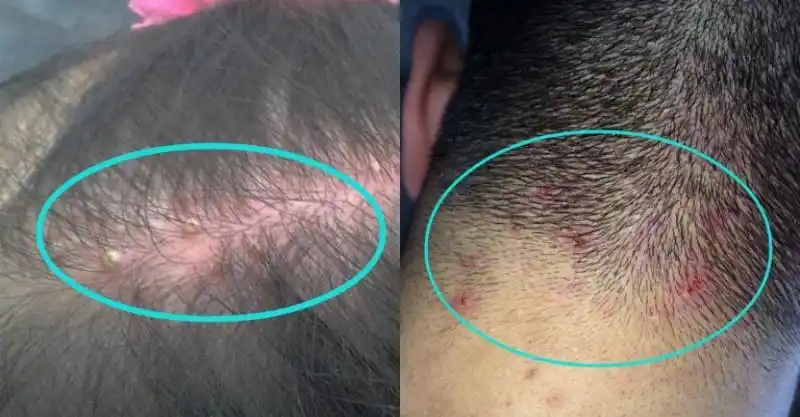 为什麼头皮老是「长痘痘」还一直长出来!原因竟然是.