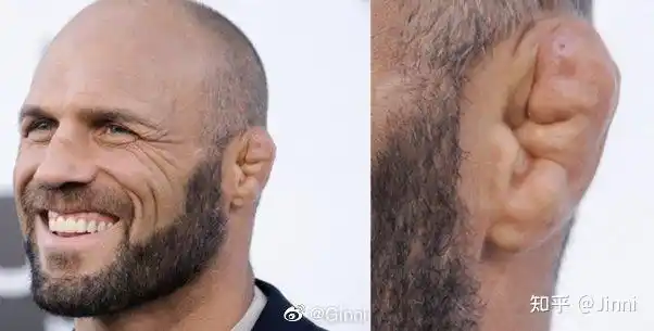 都说练巴西柔术会有饺子耳为什么很多明星练巴西柔术却不会出现饺子耳